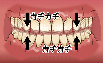 タッピング(上下歯列接触癖)