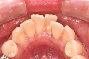 歯石除去（SC）