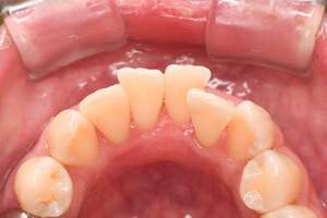 歯石除去（SC）