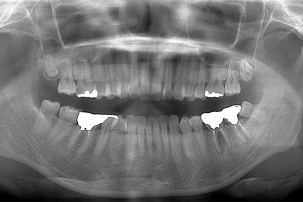 レントゲン写真（治療前）