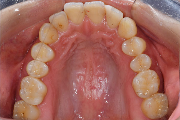 治療後（下から見た写真）