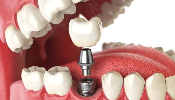 インプラントを歯に埋め込んだ口内の状態のイメージ
