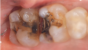 麻布十番歯科で虫歯症例の治療後の画像