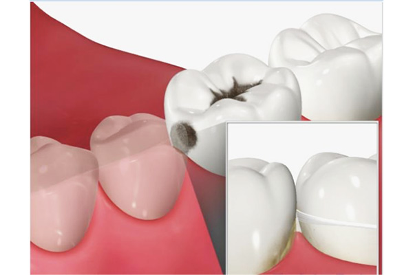 歯と歯の間に虫歯ができる歯のイメージ画像