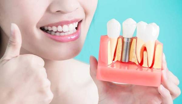 インプラントを埋め込んだ歯の模型を持っている女性のイメージ