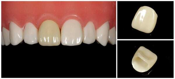 ジルコニアクラウン