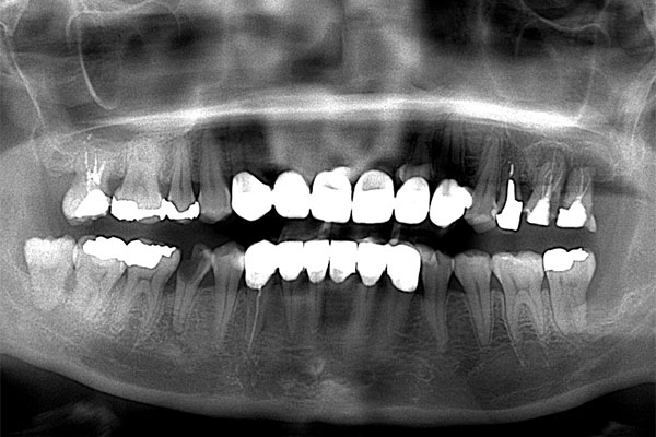 レントゲン写真（治療前）