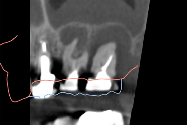 レントゲン写真全体（治療前）