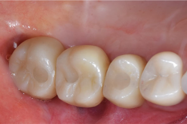 インプラント治療後