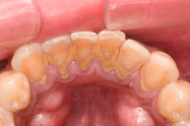 歯石除去（SC）