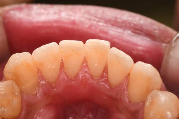 歯石除去（SC）