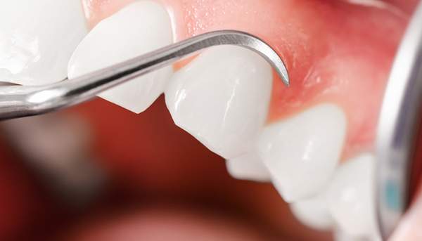 歯ぐきの状態を歯科医院で検査しているイメージ