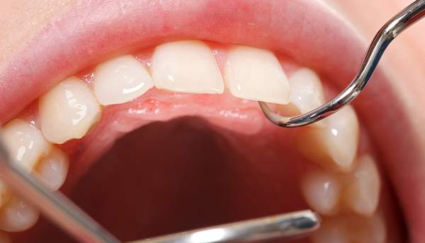 歯の裏側の状態を歯科用器具で確認するイメージ