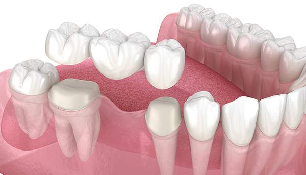 詰め物がとれてしまう原因