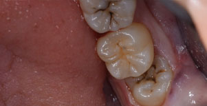 歯茎に埋まっている親知らず