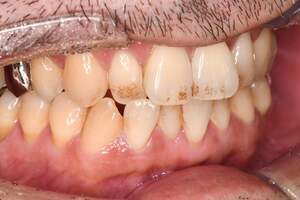 着色除去（PMTC）