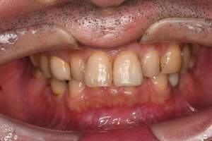 歯石除去（SC）