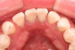 歯石除去（SC）