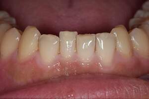 歯石除去（SC）