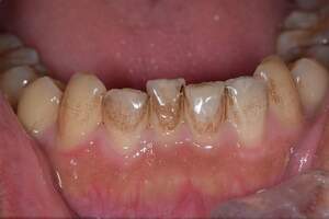 歯石除去（SC）