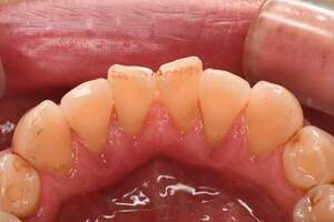 歯石除去（SC）