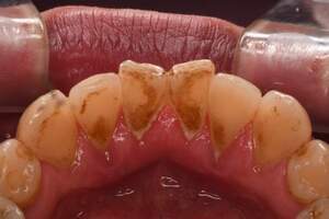 歯石除去（SC）