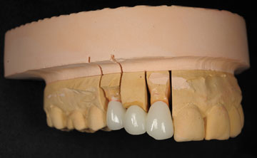 治療方法1:ブリッジ