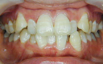 歯並びが乱れているイメージ写真