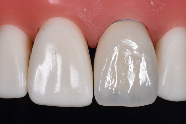 オールセラミック プレミアム