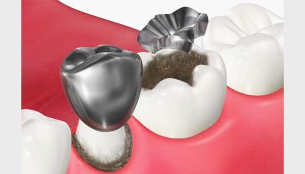 詰め物・被せ物による二次カリエス