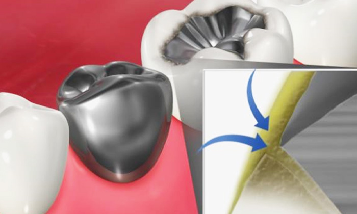 歯と詰め物の隙間に汚れが溜まっているイラスト