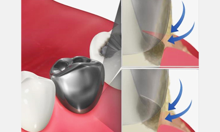 歯と被せ物の隙間に汚れが溜まっているイラスト