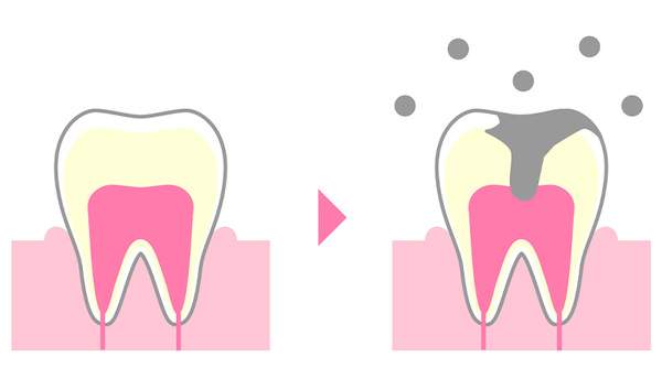 健康な歯と虫歯になった歯のイラスト