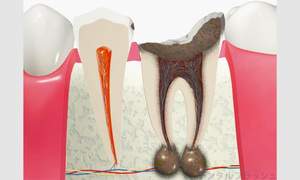 C4の虫歯が進行し根の先に膿が溜まっている断面図