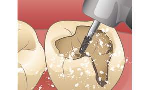 虫歯の部分を取り除いているイラスト