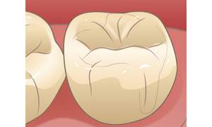 かみ合わせを確認し形を整えた後の歯のイラスト