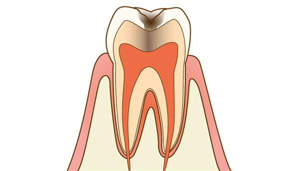 C2の歯の断面図のイラスト