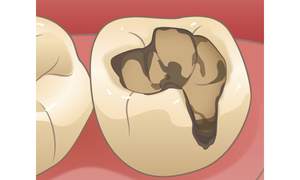 虫歯になっている歯のイラスト