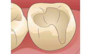 虫歯を取り除いた歯の型どりをしているイラスト