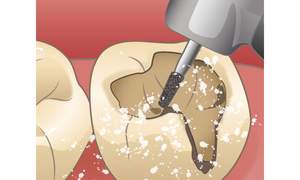 虫歯の部分を取り除いているイラスト