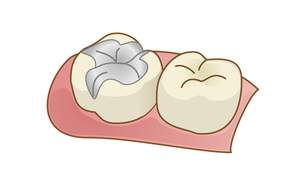 後日詰め物を入れた状態のイラスト