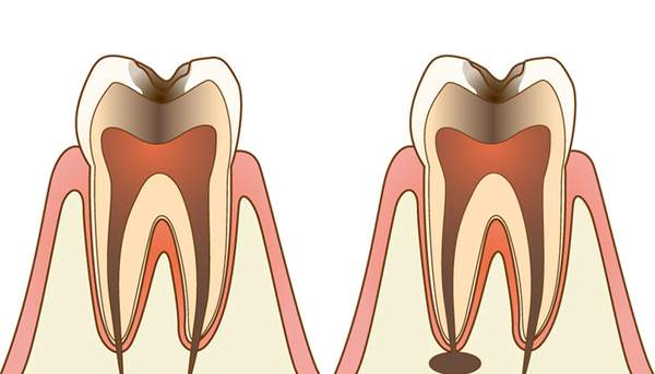 C3の虫歯とさらに膿がたまっている歯の断面図のイラスト