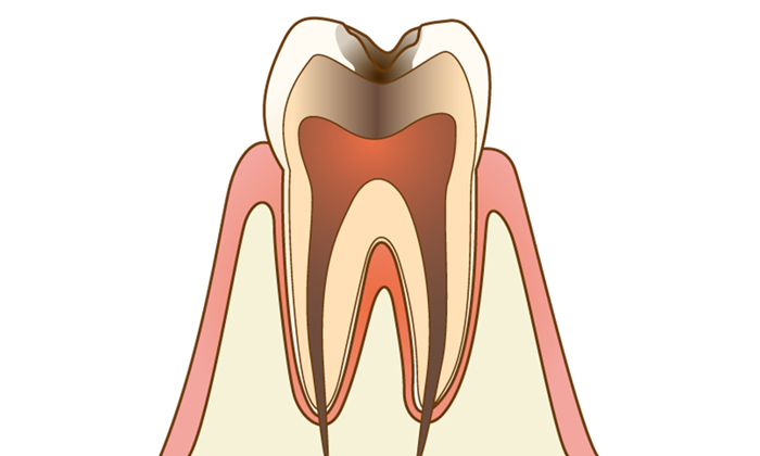 虫歯になっている歯の断面図
