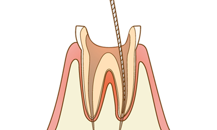 神経を取り除いているイラスト