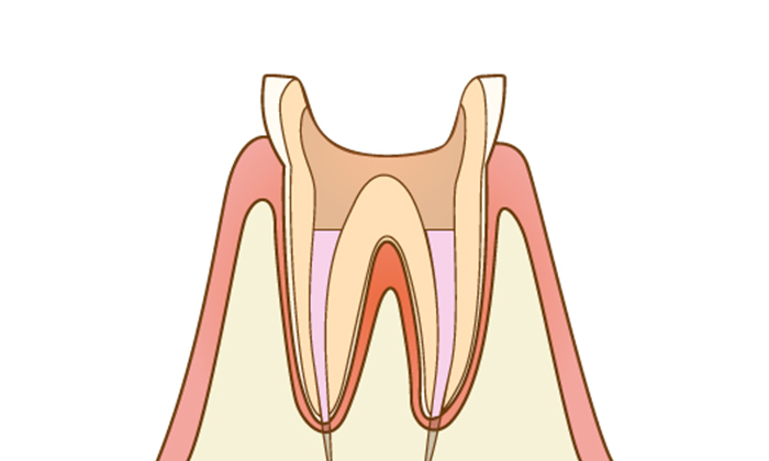 根の先端に薬が入った状態の歯のイラスト