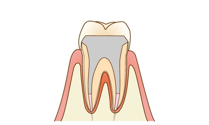 薬をいれた上にファイバーコアという土台を入れたイラスト