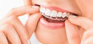 マウスピース矯正で使用する矯正装置を装着した歯のイメージ