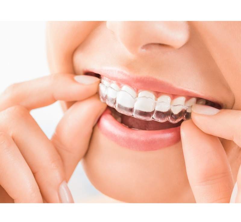 麻布十番歯科で矯正治療中の女性がマウスピースを装着するイメージ