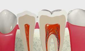 C1の初期虫歯の歯の断面図