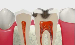 C2の虫歯が象牙質まで進んでいる歯の断面図